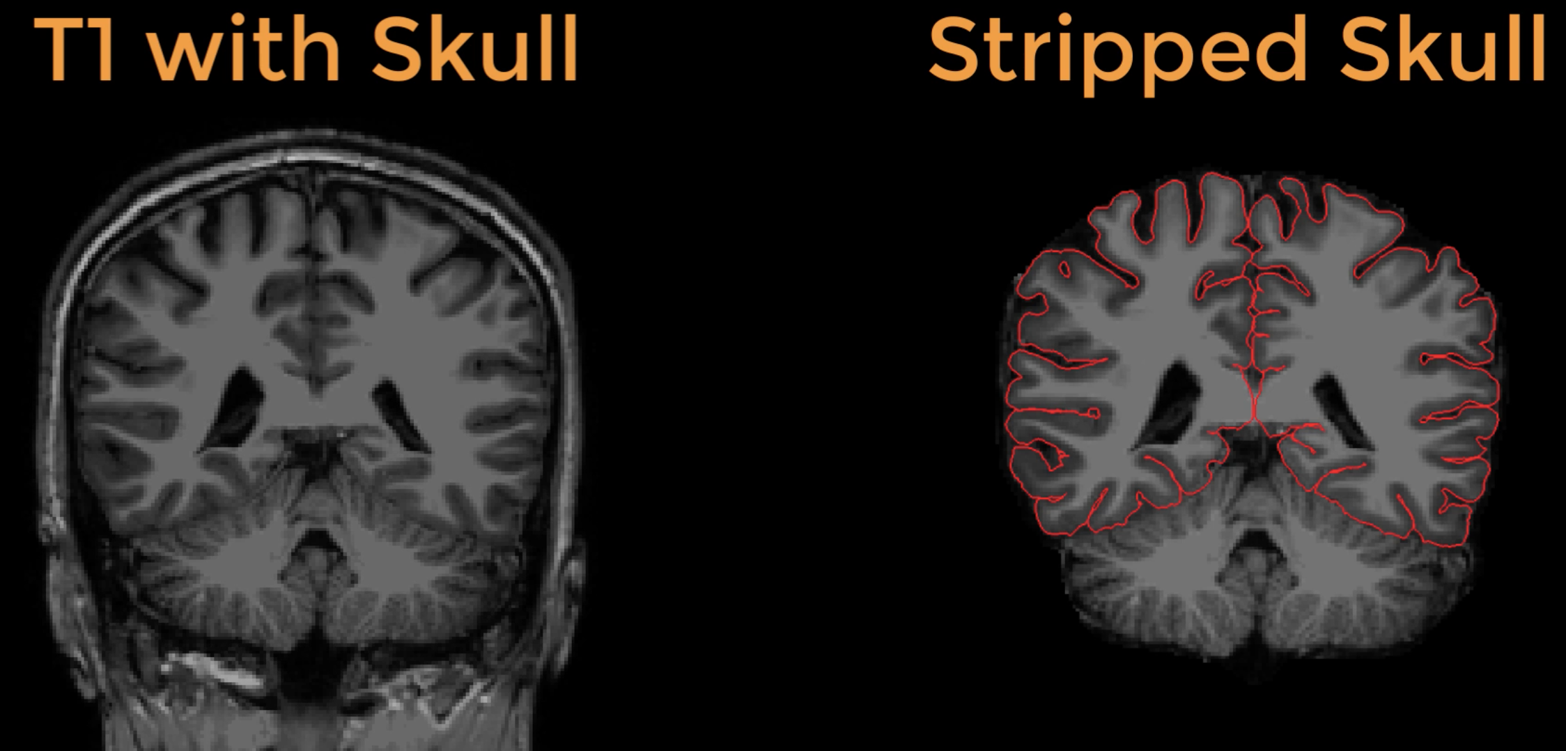 Skull Stripping